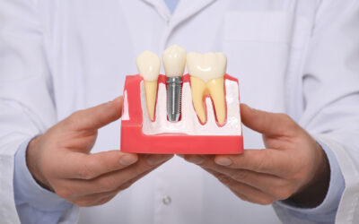 The Many Benefits of Dental Implants