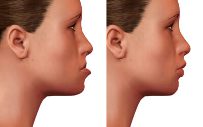 Functional and Aesthetic Solutions with Jaw Surgery