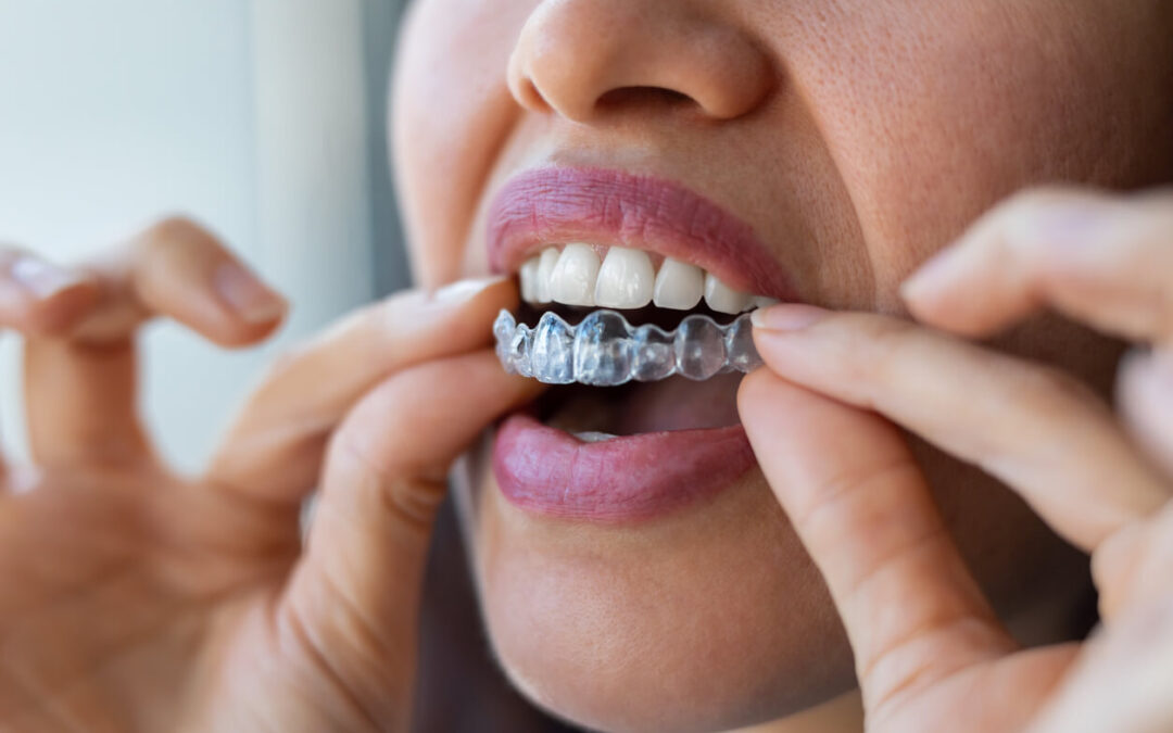 How Invisalign Transforms Smiles and Lives