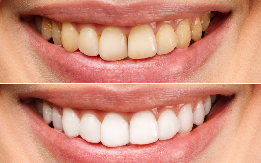 The Power of a Brighter Smile and Why Professional Teeth Whitening Is Worth It