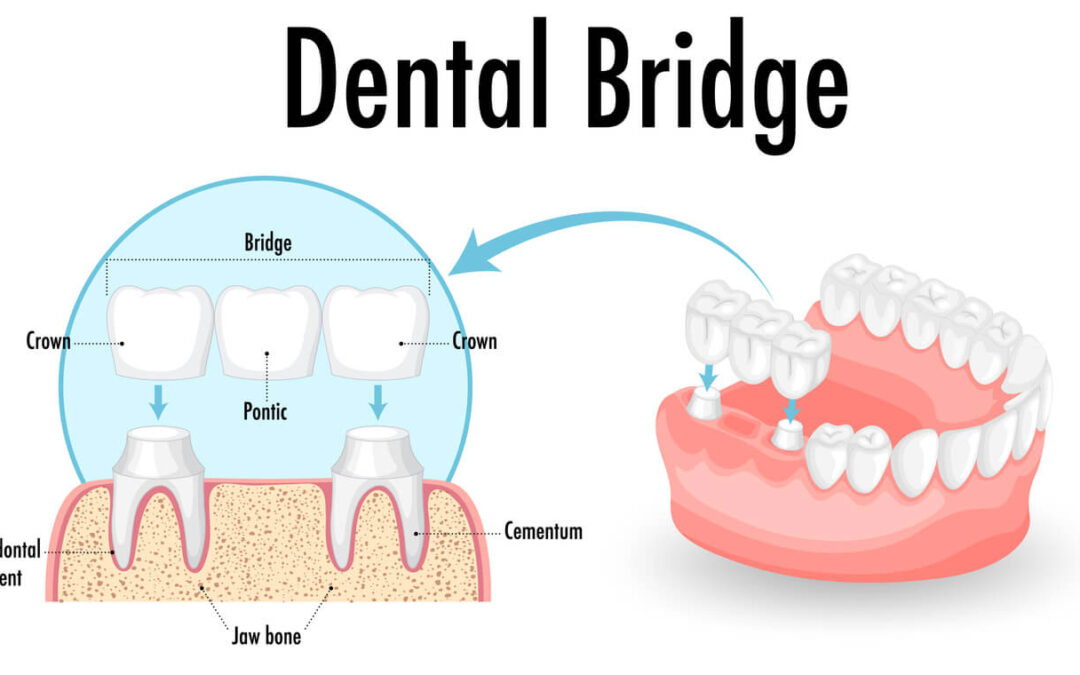 Understanding Dental Bridges and How Many Teeth They Can Replace
