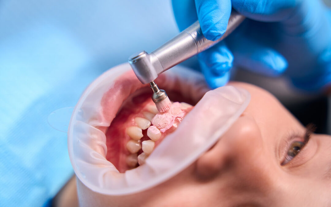 How Often Should You Have a Dental Cleaning?